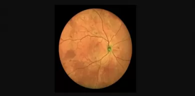 Six Conditions Detectable with a Retinal Camera