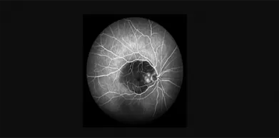 What is a Retinal Scan?