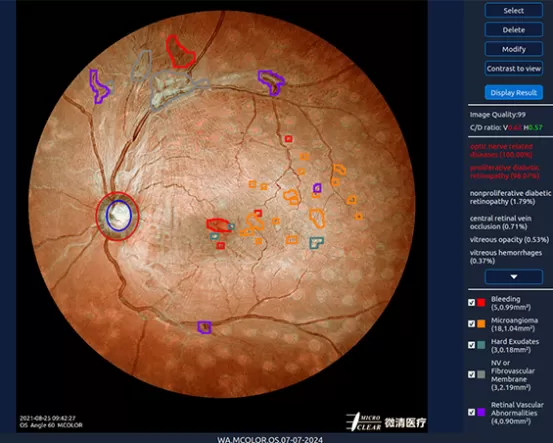 MICROCLEAR RETINA ASSISTANT